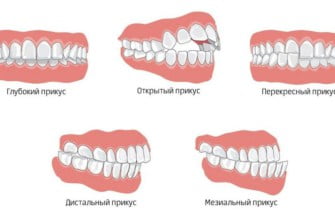 Неправильный прикус зубов – виды, как исправить, последствия